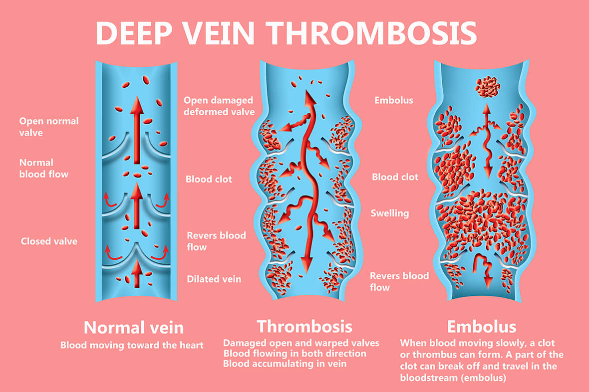 Trombose é a formação de um coágulo sanguíneo em um vaso sanguíneo. 